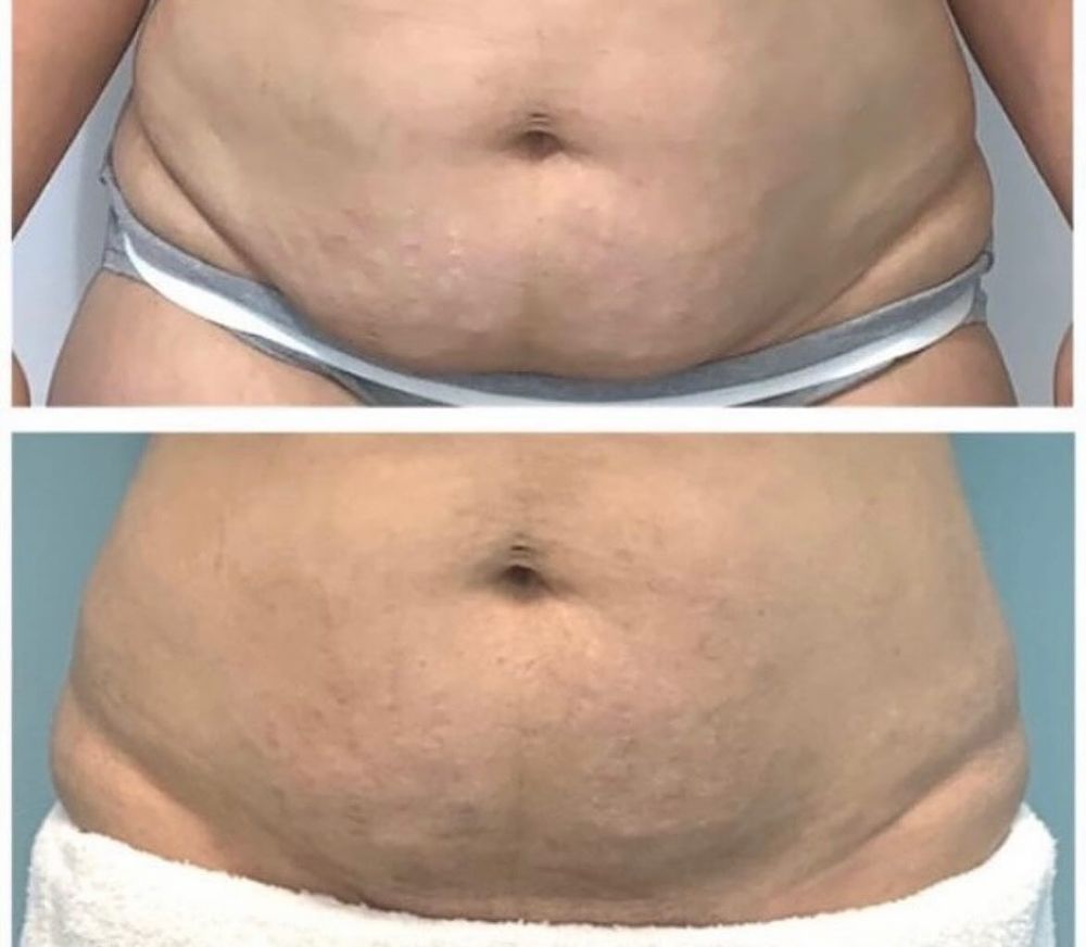 All Photos for Arctic Cryotherapy Bayonne in Bayonne, NJ