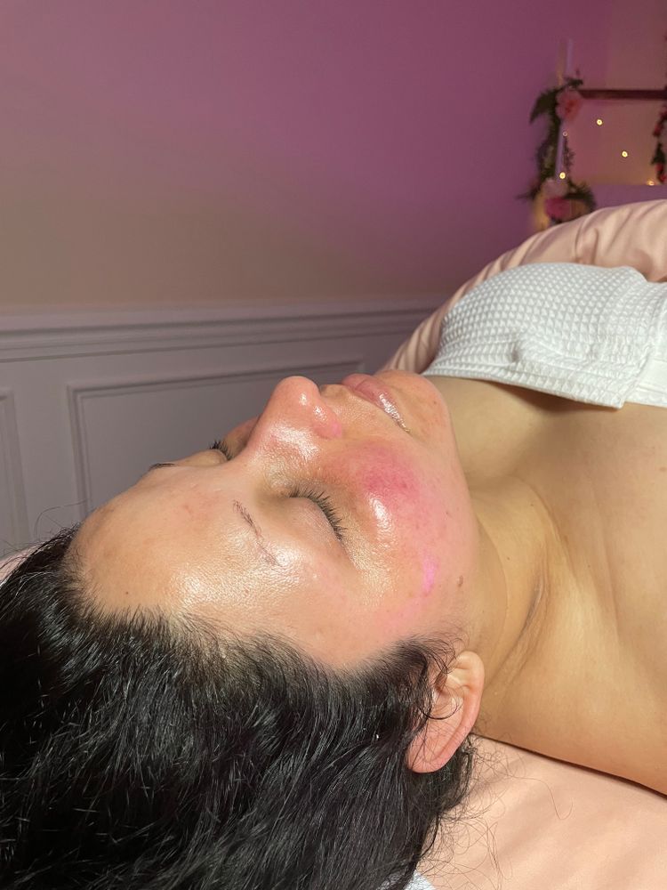 Microdermabrasion for Luxury Aesthetics Spa in Savannah, Georgia