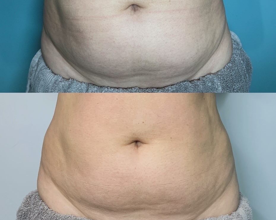 All Photos for Arctic Cryotherapy Bayonne in Bayonne, NJ