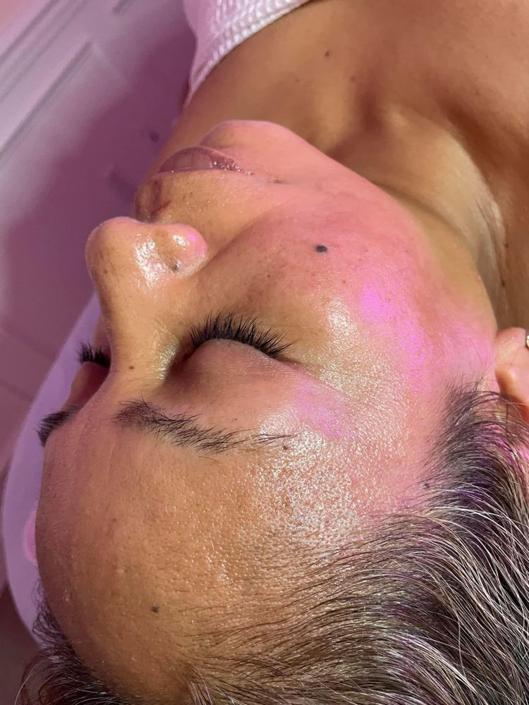 Microdermabrasion for Luxury Aesthetics Spa in Savannah, Georgia