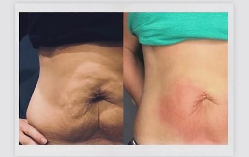 All Photos for Arctic Cryotherapy Bayonne in Bayonne, NJ