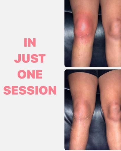 Local Cryotherapy for Arctic Cryotherapy Bayonne in Bayonne, NJ
