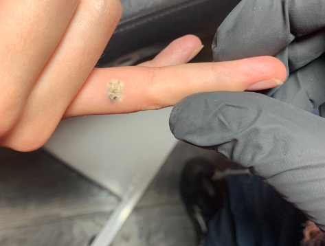 Laser Tattoo Removal for RedInk Tattoo Studio in Manhattan,  NY