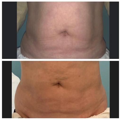 T-Shock Body for Arctic Cryotherapy Bayonne in Bayonne, NJ