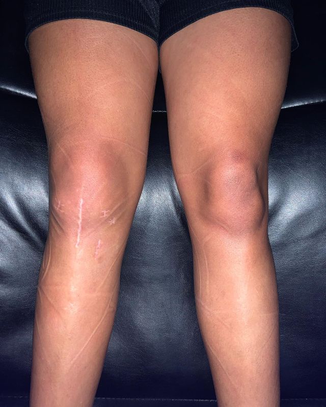 Local Cryotherapy
