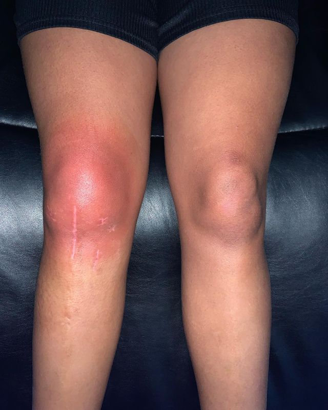 Local Cryotherapy