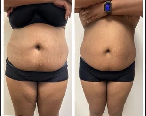 Bodysculpting